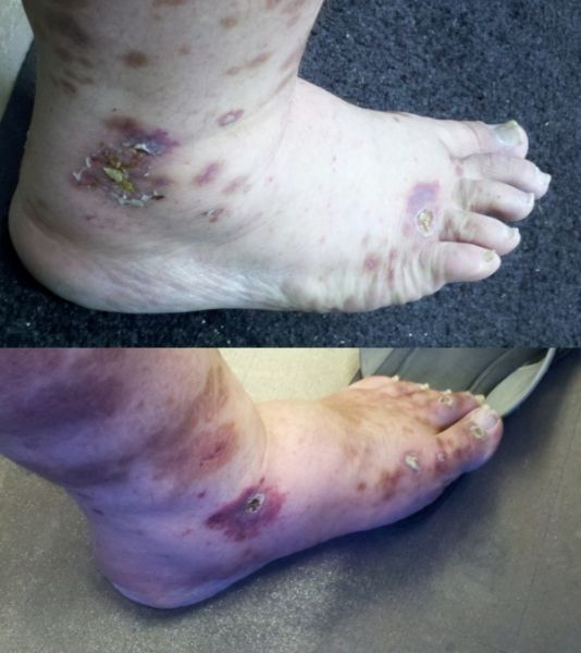 File:LV 2013-05-24 both ankles.jpg
